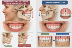 Pembe Estetik (Gummy Smile) Nedir? Diş Eti Estetiği Nasıl Yapılır? 4 2. İskeletsel ve Kemik Kaynaklı Nedenler