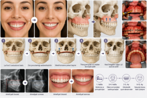 Pembe Estetik (Gummy Smile) Nedir? Diş Eti Estetiği Nasıl Yapılır? 13 6. Ortognatik Cerrahi (Çift Çene Ameliyatı)