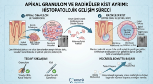 Apikal Granulom ve Radiküler Kist Ayrımı
