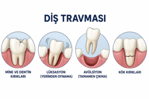 Diş Travması Nedir ve Temel Hasar Türleri Nelerdir