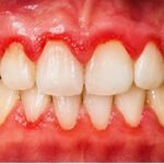 Gingivitis Nedir?
