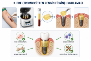 Kemik Erimesi İlacı Kullananlarda İmplant Tedavisi Yapılır mı? 21 3. PRF (Trombositten Zengin Fibrin) ve Kök Hücre Uygulamaları