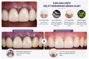 Kaplama dişte diş eti morarması neden meydana gelir