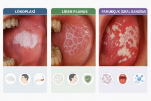 Lökoplaki, liken planus ve pamukçuk (oral kandida) ayrımı