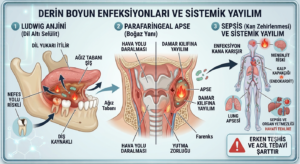 Parafaringeal apse, Ludwig anjini ve Sepsis (Kan zehirlenmesi)