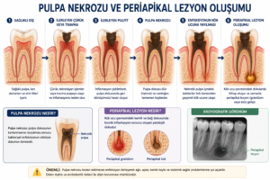 Pulpa nekrozu ve periapikal lezyon oluşumu