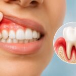 Diş Eti İltihabı Nedir, Nasıl Geçer? (Belirtileri ve Tedavisi) 2 Kızarmış ve şişmiş diş eti iltihabı (gingivitis) belirtileri gösteren hasta ağzı ve diş kökü enfeksiyonu animasyonu
